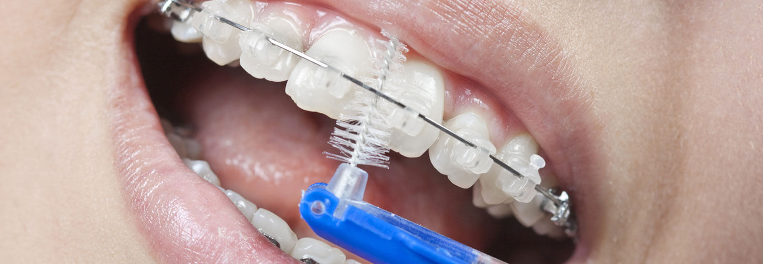 brushing with braces