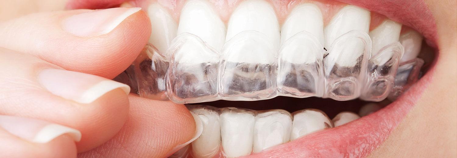 clear teeth aligners