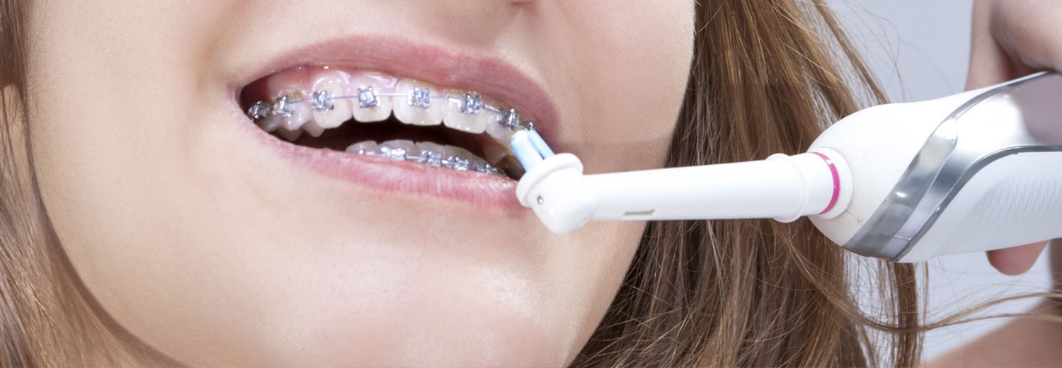 How To Keep Your Teeth Clean With Braces Valderrama Orthodontics